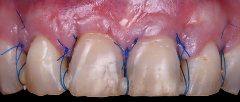 . Situation clinique à 10 jours post-opératoire avant dépose des sutures