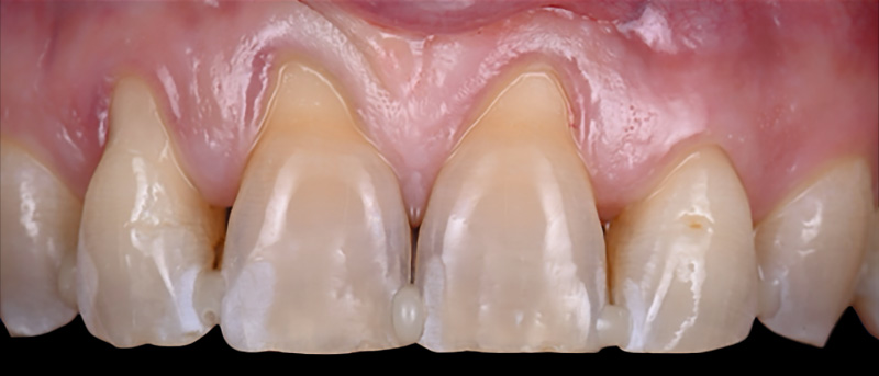 tunnel tracté coronairement, état initial