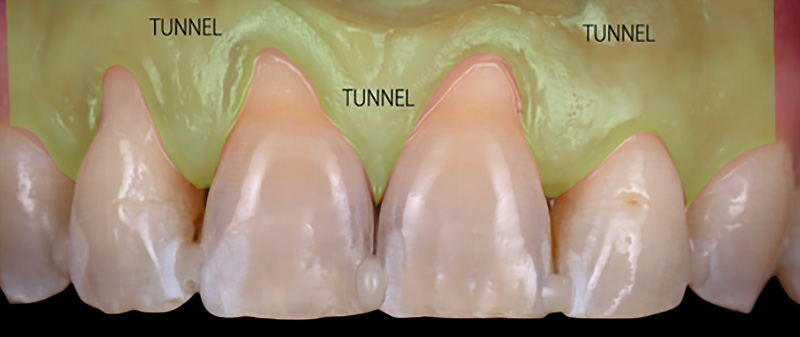 Description du tracé d’incision de tunnel modifié et tracté coronairement
