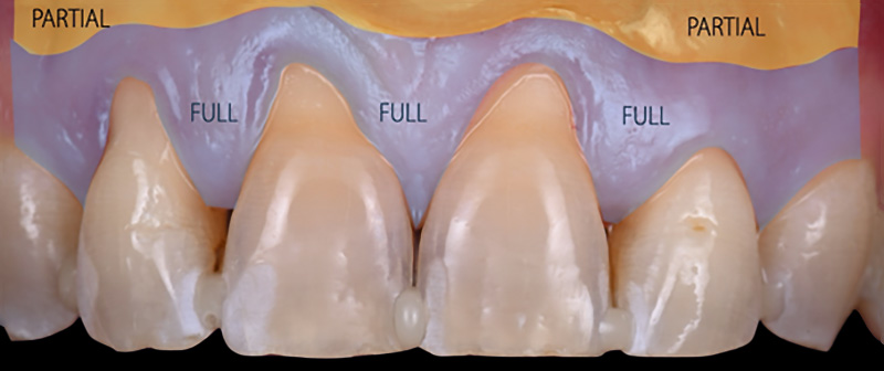 zones de décollement jusqu’à la ligne muco-gingivale et zones de dissection au-delà de la ligne muco-gingivale