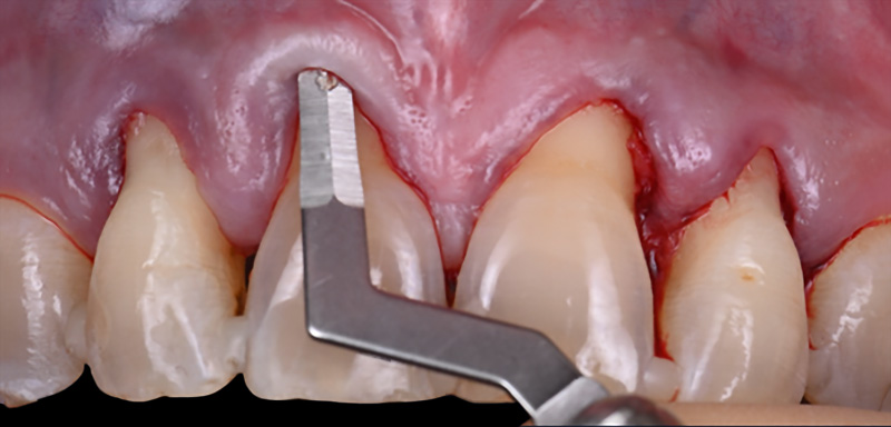 Incisions intra-sulculaires à l’aide d’une lame MJK® BW002