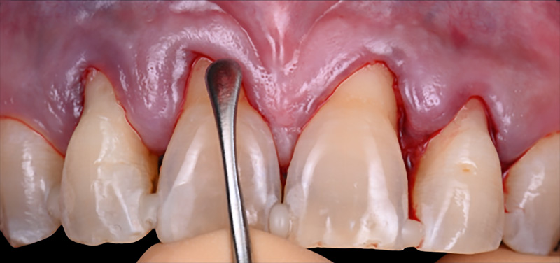 Décollement jusqu’à la ligne muco-gingivale à l’aide de micro-décolleur Depeller®
