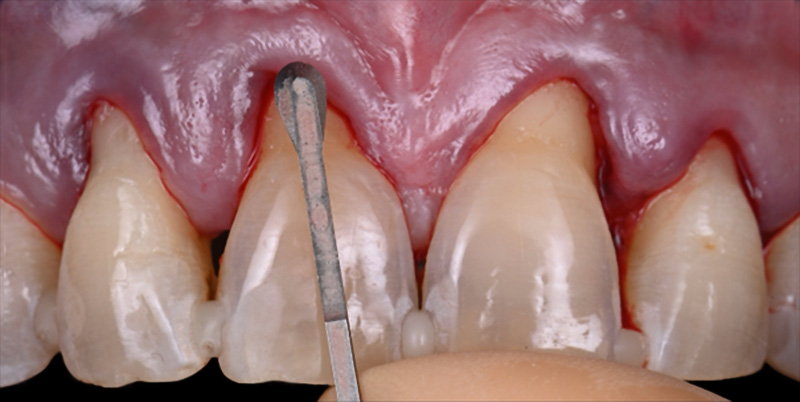 Dissection au délà de la ligne muco-gingivale à l’aide de micro lame MJK spoon-blade®