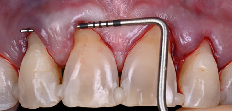 Vérification de la laxité du lambeau à l’aide d’une sonde parodontale