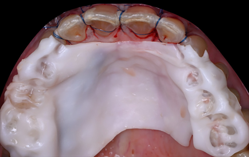 Vue occlusale de l’arcade maxillaire décrivant la protection du palais à l’aide d’une plaque palatine réalisée en méthode directe Elemental®