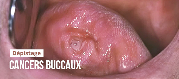 Slider-Article-SIMART-cancers-cavite-buccale