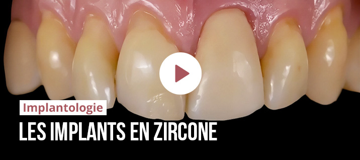 Slider-Article-implants-zircone-BOI