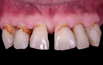 FujiCEM Evolve, étude de cas