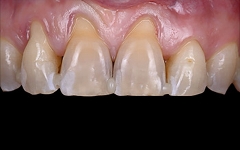 tunnel tracté coronairement, état initial