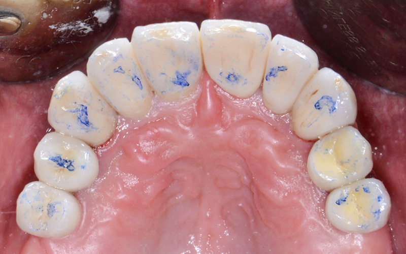 Vérification fonctionnelle de l’occlusion au niveau de l’arcade maxillaire