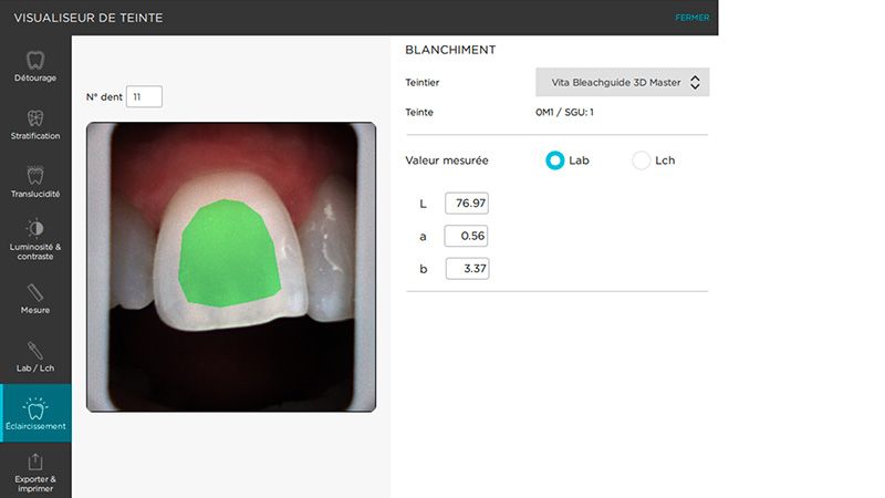 Analyse de la teinte de la dent