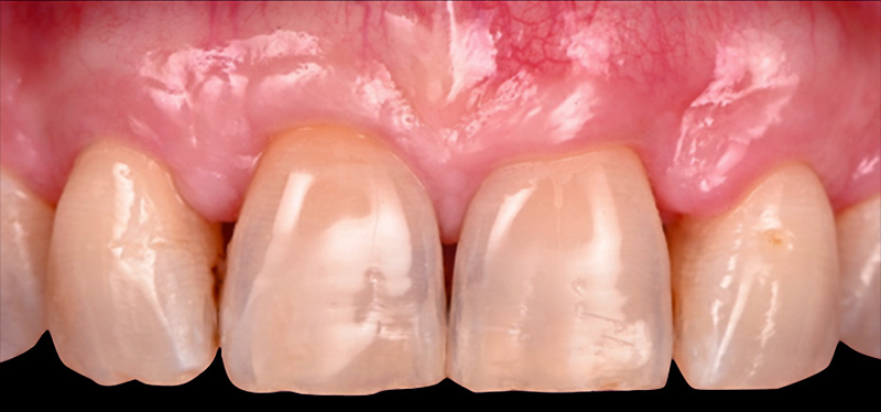 Situation clinique à 6 mois post-opératoire
