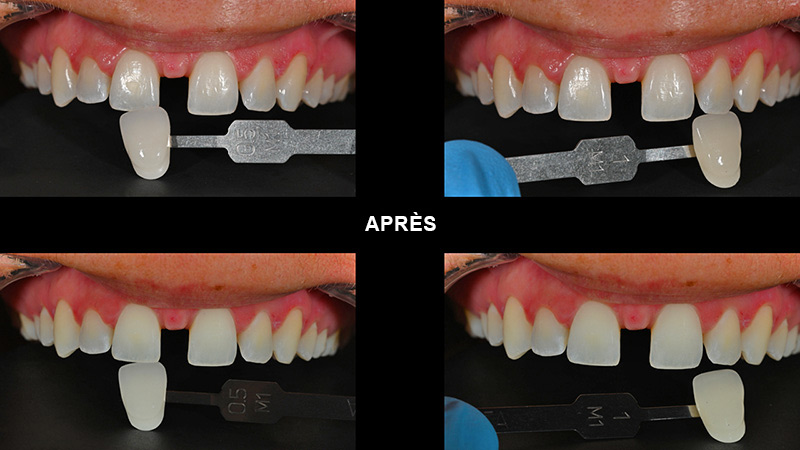 Relevé de teinte 15 jours après la fin du traitement