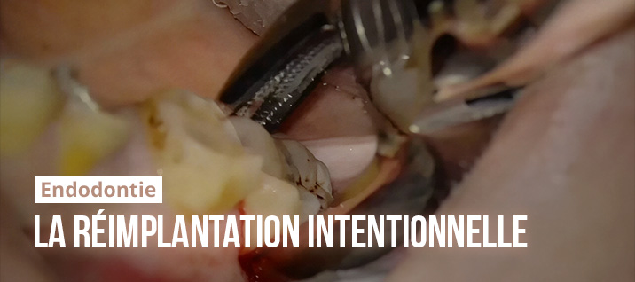 Slider-Article-Benjamin-Boublil-Reimplantation