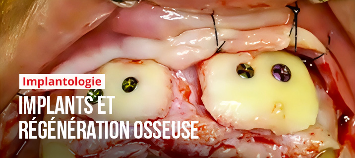 Slider-Article-Replay-Khoury-implants