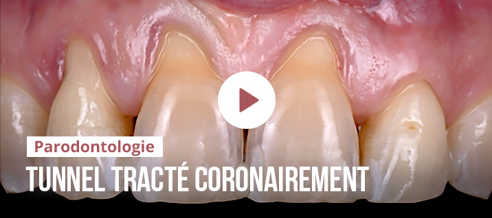 Slider-Article-Romain-Ohanessian-TUNNEL_V2