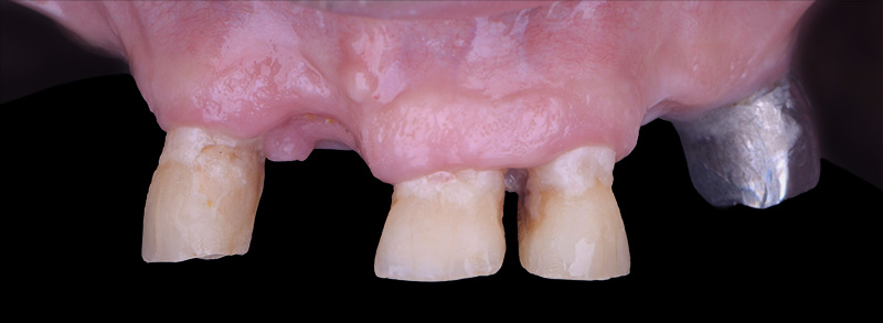 implantologie, patient adressé pour une réhabilitation complète
