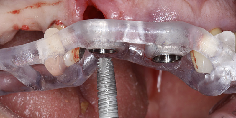 implantologie, chirurgie guidée