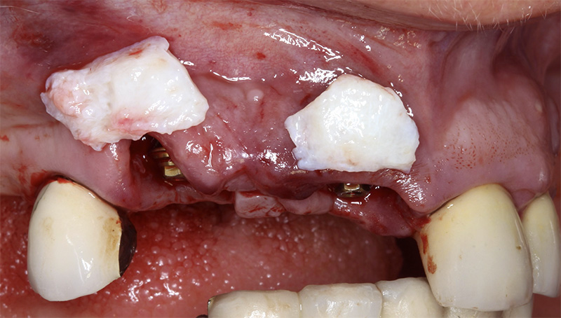 implantologie, greffe de conjonctif tubérositaire