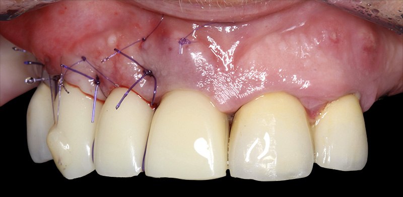 implantologie, situation postopératoire immédiate