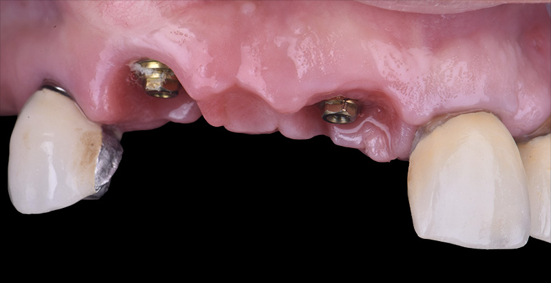 implantologie, cicatrisation à 3 mois