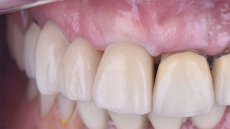 implantologie, prothèse d’usage en place