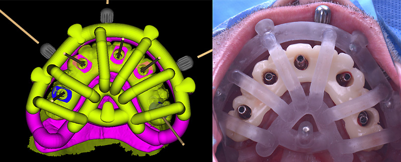 implantologie, bridge provisoire en place sur guide à étage