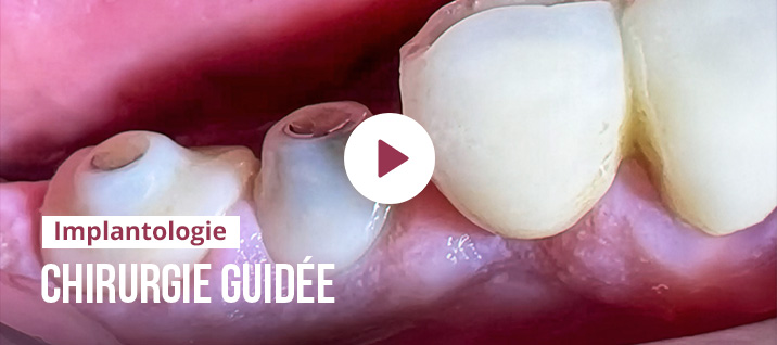 Slider-Article-Replay-Rodolphe-MARTIN-Implantologie