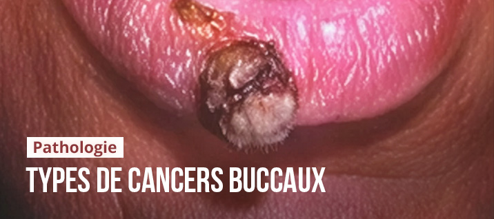 Slider-Article-Stephane-Simart-cancers-buccaux
