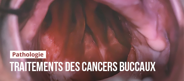Slider-Article-Stephane-Simart-traitements-cancers-cavite-buccale