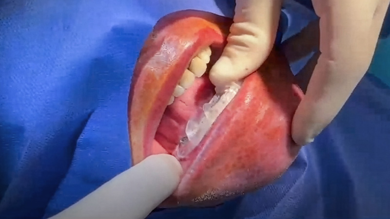 implantologie guidée