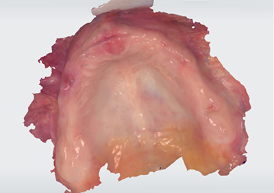 numérisation des crêtes édentées d'un patient