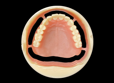 Prothèse monolithique usinée dans un disque bicolore