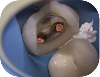 Photo post-opératoire après WVC