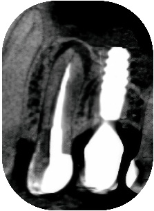 prémolaire, la corticale sous-sinusienne est intacte.