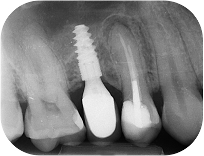 prémolaire, radio pré-opératoire