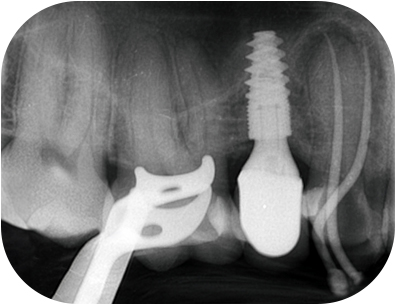 prémolaire, radio per-opératoire cone en place