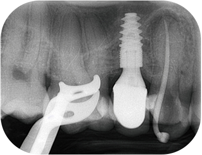 radio per-opératoire cone ajusté
