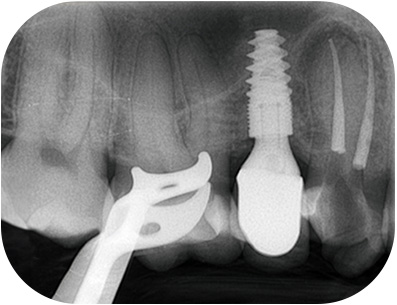 Radio per-opératoire après WVC