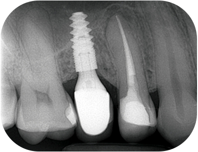 Radio post-opératoire après collage