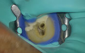 traitements endodontiques