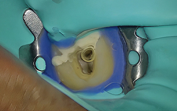 traitements endodontiques
