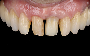 La facette sur coiffe