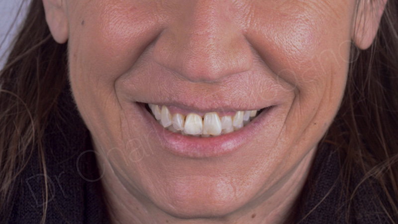 La facette sur coiffe, état initial de la patiente