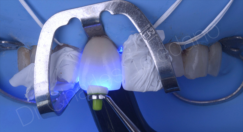 Couronne sur 11 et trois facettes en disilicate de lithium