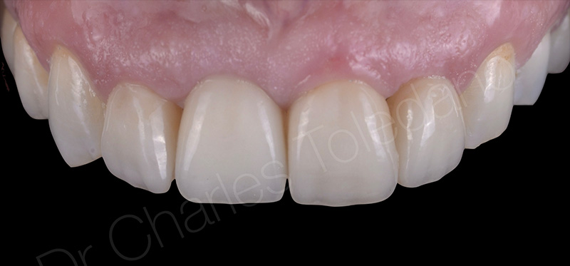  facette, résultat final