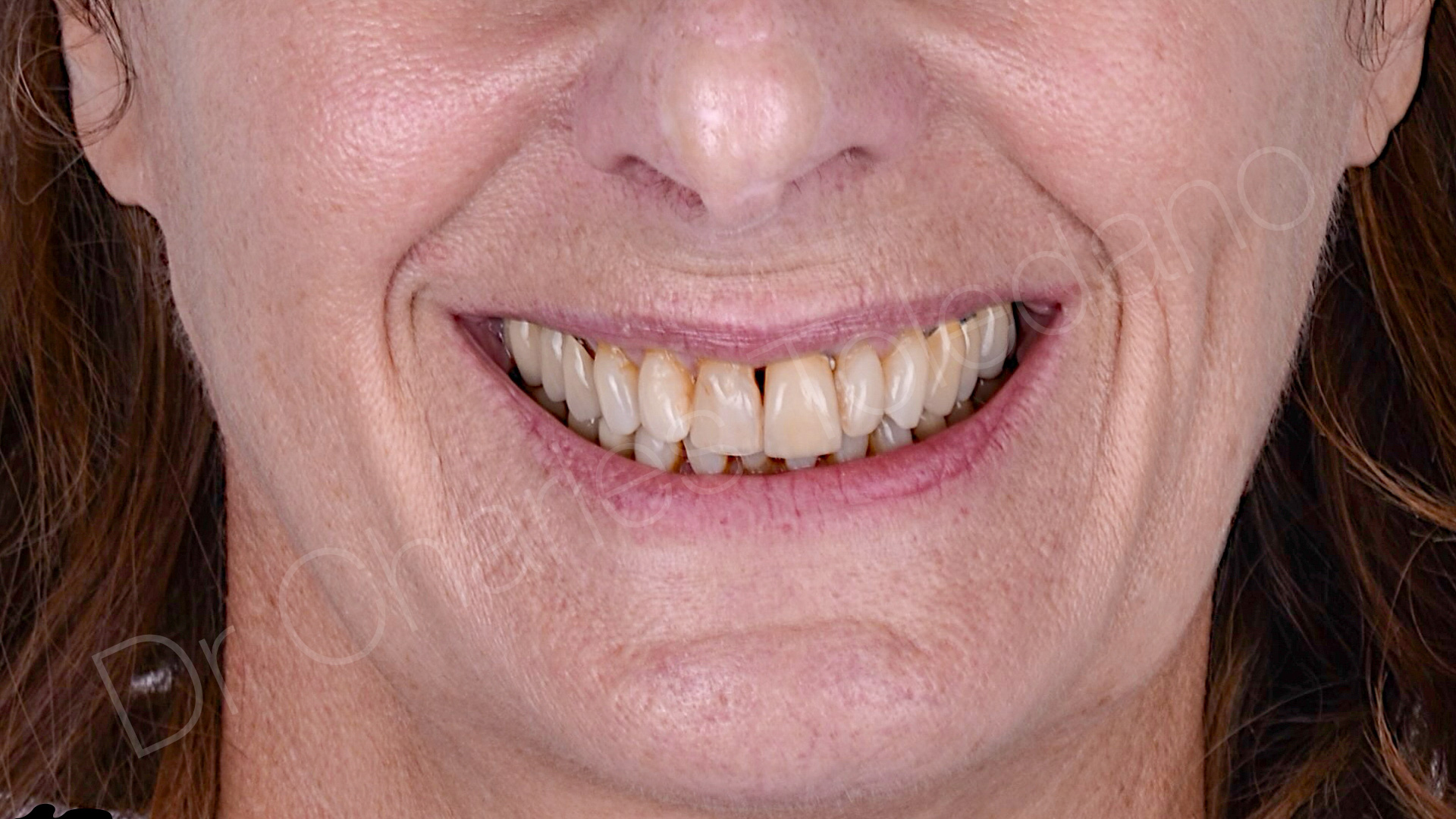 Etat initial, patiente, gêne esthétique