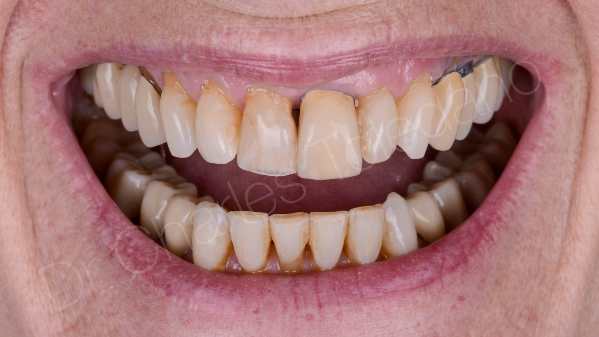 Etat initial, patiente, récessions gingivales