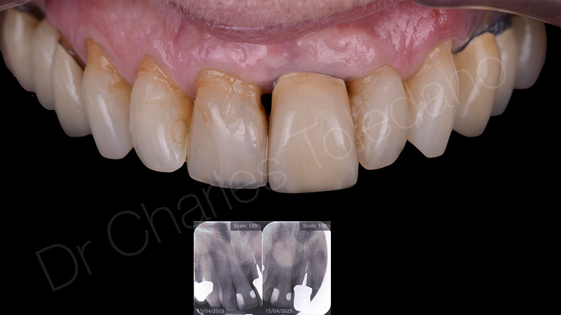 Facette, la 11 est vitale et restaurée par deux anciens composites