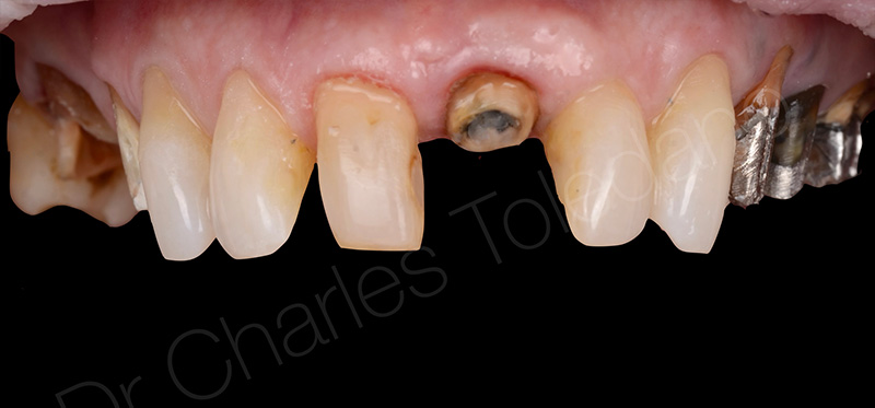 Etat après dépose des anciennes couronnes